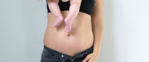 how-to-get-rid-of-belly-stretch-marks-after-pregnancy-2