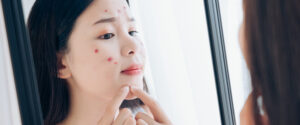 how-to-cure-acne-pregnancy